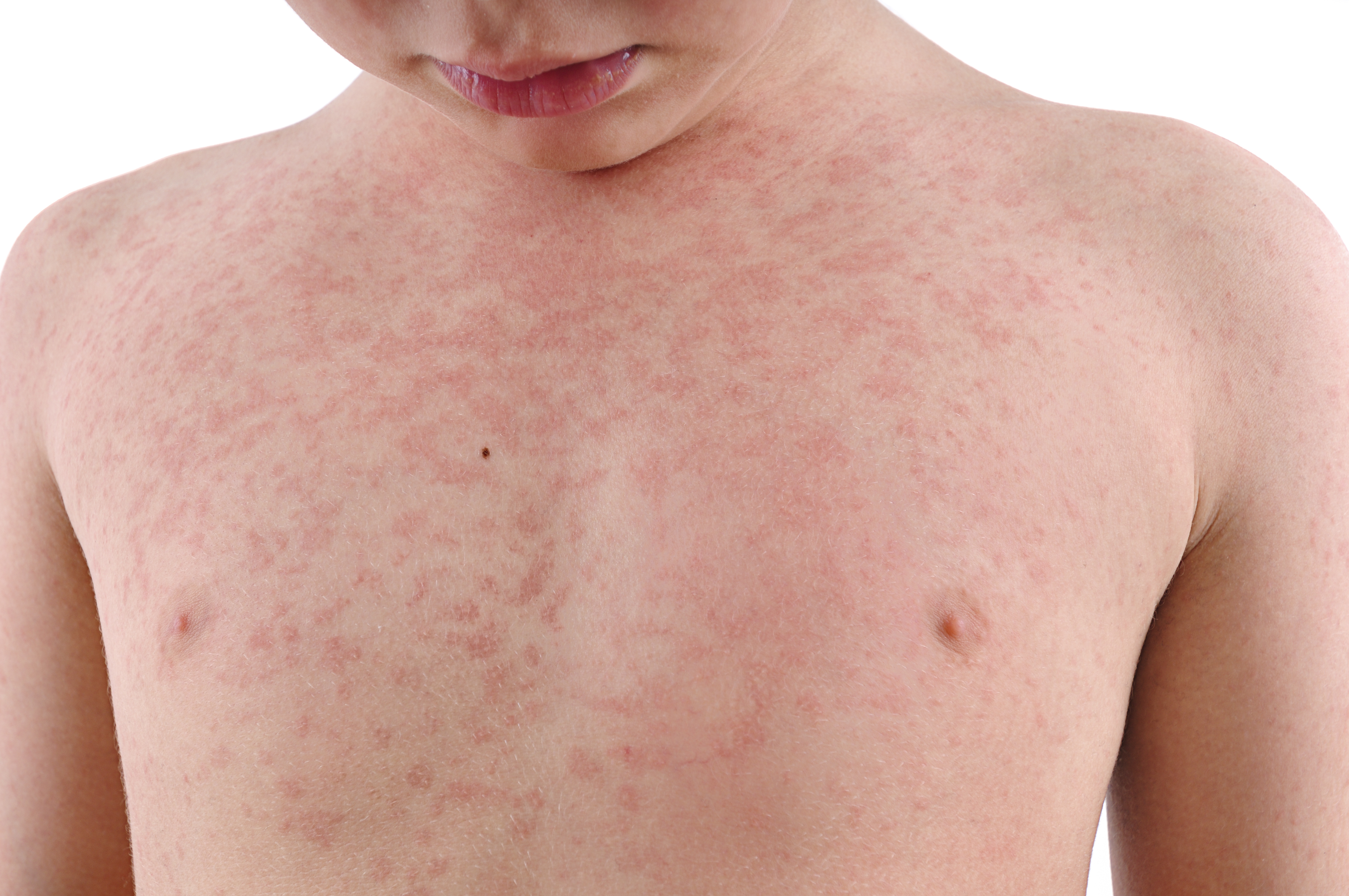 Plagued by a summer rash? How to tell if it's heat rash or