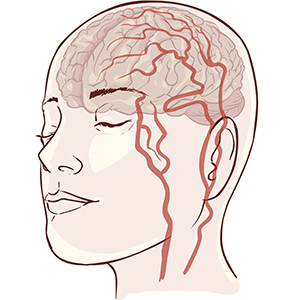 Subarachnoid Hemorrhage: Symptoms, Causes & Risk Factors