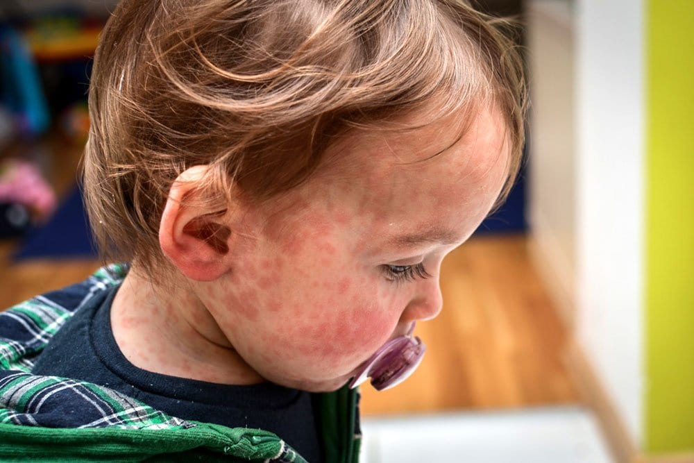 photo of a toddler measles patient