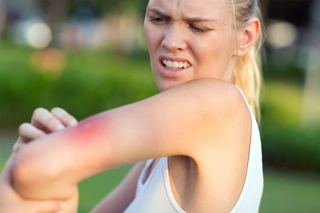 photo of a red spot on arm of a woman