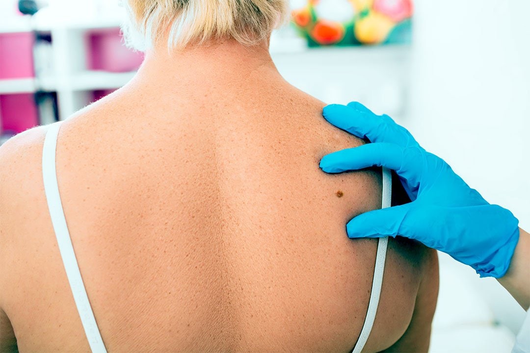 photo of a mole on a woman's back