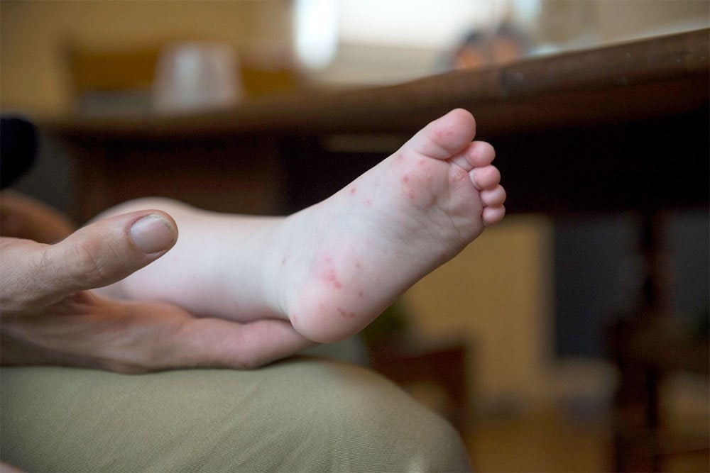 photo of a father holds his baby girl who has Hand, Foot, and Mouth Disease, which is a comon infection caused by a group of viruses