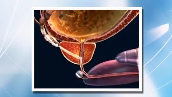 prostate-surgery-prostatectomy